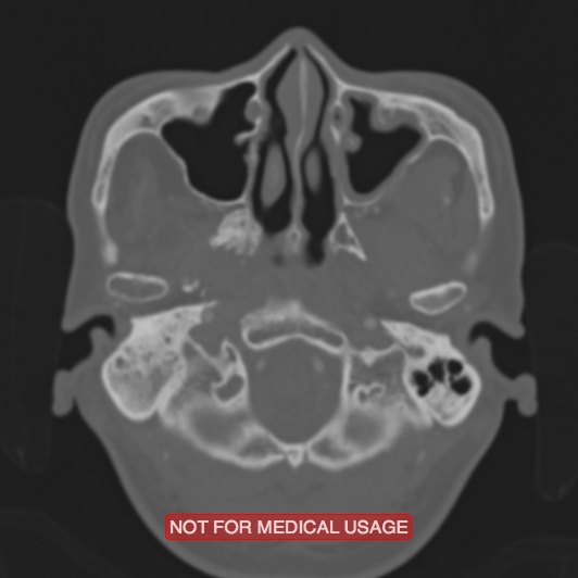 Nasopharyngeal carcinoma recurrence - skull base destruction (Radiopaedia 29107-29490 Axial bone window 92).jpg