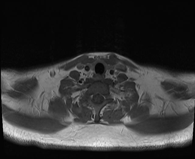 File:Nasopharyngeal carcinoma with perineural spread (Radiopaedia 55030-61380 Axial T1 4).jpg