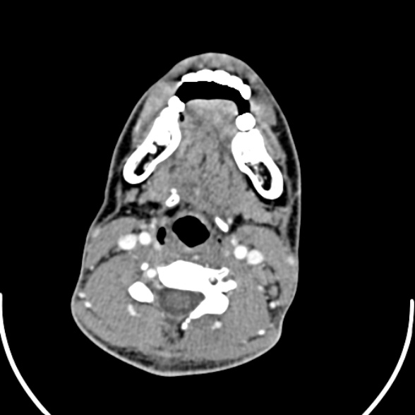 File:Nasopharyngeal carcinoma with skull base invasion (Radiopaedia 53415-59705 A 125).jpg