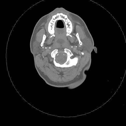 Neck CT angiogram (intraosseous vascular access) (Radiopaedia 55481-61945 B 242).jpg
