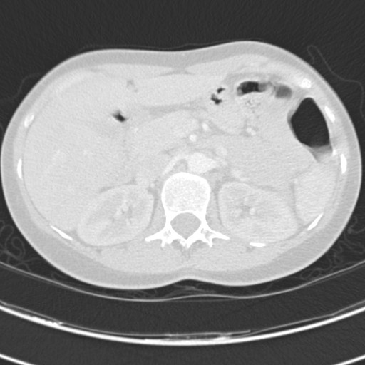 File:Necrobiotic pulmonary nodules - Crohn disease (Radiopaedia 20723-20631 Axial lung window 151).jpg