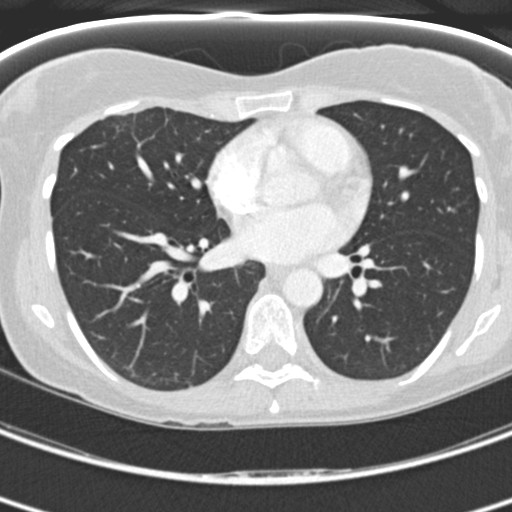 Necrobiotic pulmonary nodules - Crohn disease (Radiopaedia 20723-20631 Axial lung window 81).jpg