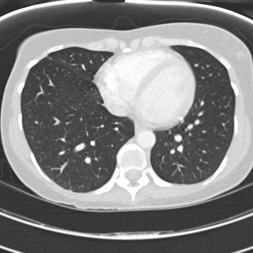 Necrobiotic pulmonary nodules - Crohn disease (Radiopaedia 20723-20631 Axial lung window 99).jpg