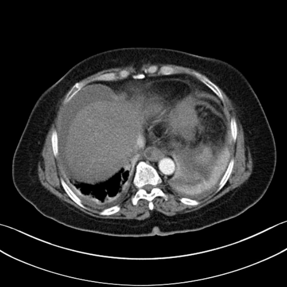 File:Necrotizing emphysematous pancreatitis (Radiopaedia 25727-25893 A 25).jpg