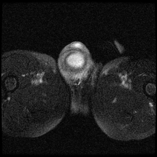 File:Necrotizing epididymo-orchitis with intra-testicular abscess (Radiopaedia 29397-29860 Axial T2 fat sat 13).jpg