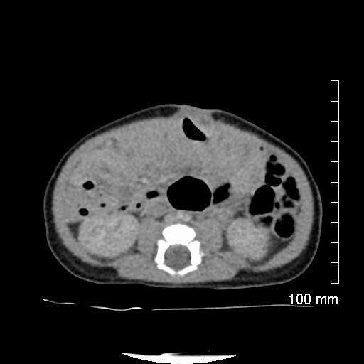 File:Neonatal neuroblastoma (Radiopaedia 56651-63438 Axial non-contrast 50).jpg