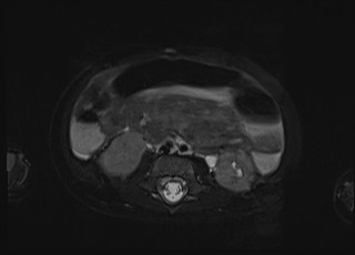 Neonatal prostatic utricle abscess - cyst (Radiopaedia 69511-79394 Axial T2 fat sat 40).jpg