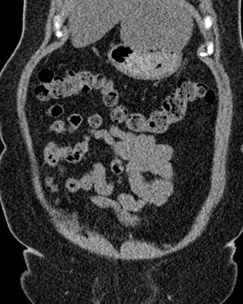 File:Nephrostomy for urosepsis (Radiopaedia 26180-26330 non-contrast 21).jpg