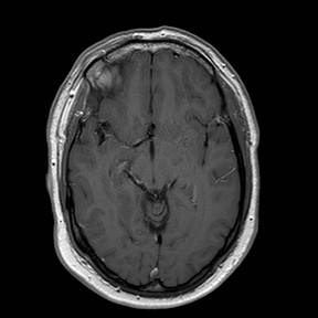 File:Neuro-Behcet's disease (Radiopaedia 21557-21506 Axial T1 C+ 13).jpg