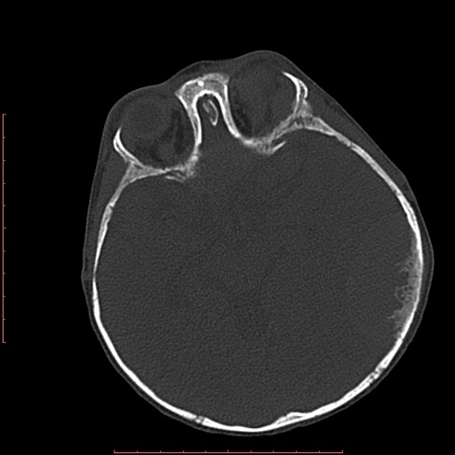 File:Neuroblastoma skull metastasis (Radiopaedia 56053-62683 Axial bone window 12).jpg