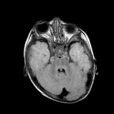 File:Neurofibromatosis type 1 (Radiopaedia 30089-30671 Axial FLAIR 7).jpg