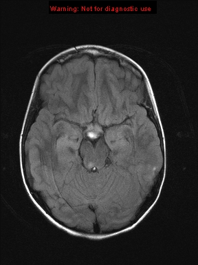 File:Neurofibromatosis type 1 with optic nerve glioma (Radiopaedia 16288-15965 Axial FLAIR 16).jpg