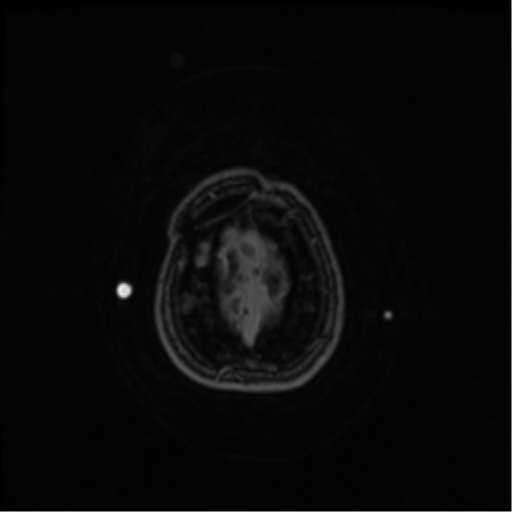 Neurofibromatosis type 2 (Radiopaedia 45229-49244 Axial T1 C+ 108).png