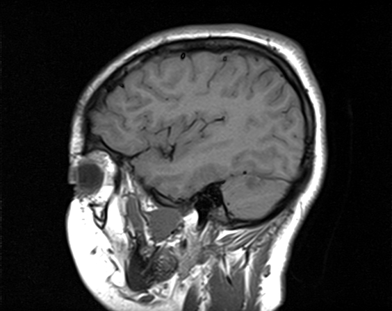 File:Neurofibromatosis type 2 (Radiopaedia 66211-75401 Sagittal T1 6).jpg