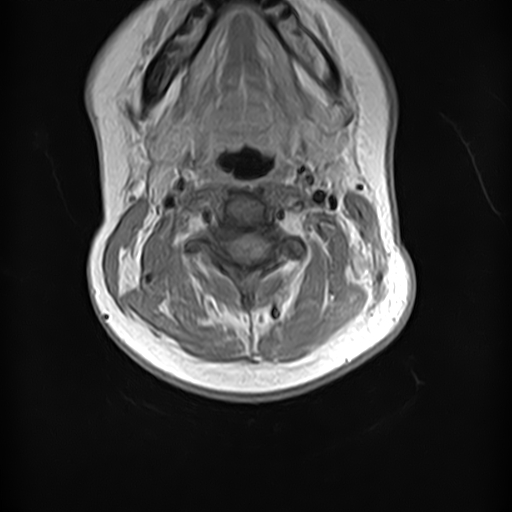 File:Neurofibromatosis type 2 (Radiopaedia 66211-75403 Axial T1 C+ 8).jpg