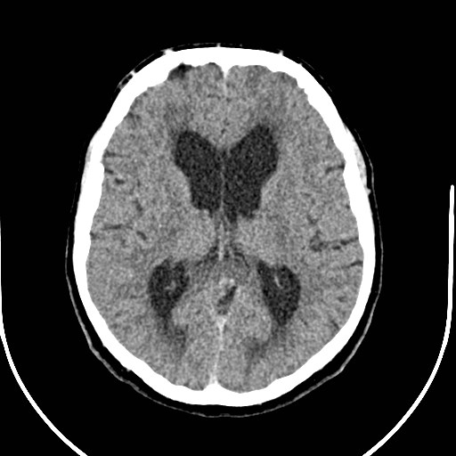 Neurofibromatosis type 2 (Radiopaedia 79097-92047 Axial non-contrast 33).jpg