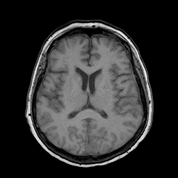 File:Neurofibromatosis type 2 (Radiopaedia 8713-9518 Axial T1 11).jpg