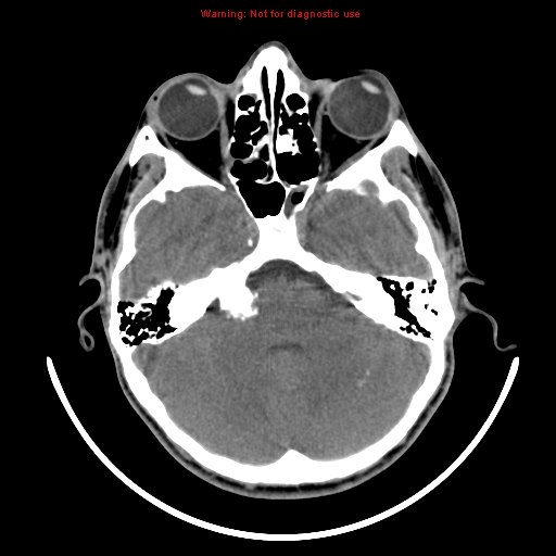 File:Neurofibromatosis type 2 (Radiopaedia 8953-9732 Axial non-contrast 9).jpg
