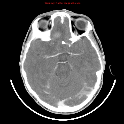 File:Neurofibromatosis type 2 (Radiopaedia 8953-9732 C 12).jpg