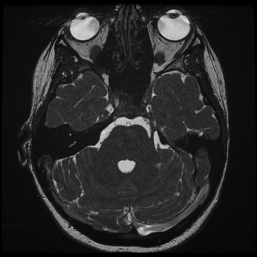 Neurofibromatosis type 2 - bilateral acoustic neuromata (Radiopaedia 40060-42566 Axial FIESTA 52).png