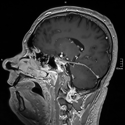 Neurosarcoidosis - involvement of the mesial temporal lobes (Radiopaedia 67429-76820 Sagittal T1 C+ 71).jpg