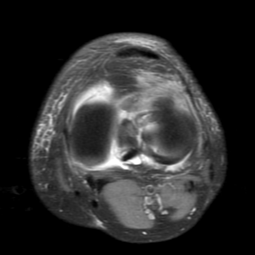 File:Non-displaced patella fracture (Radiopaedia 15932-15582 Axial PD fat sat 15).jpg