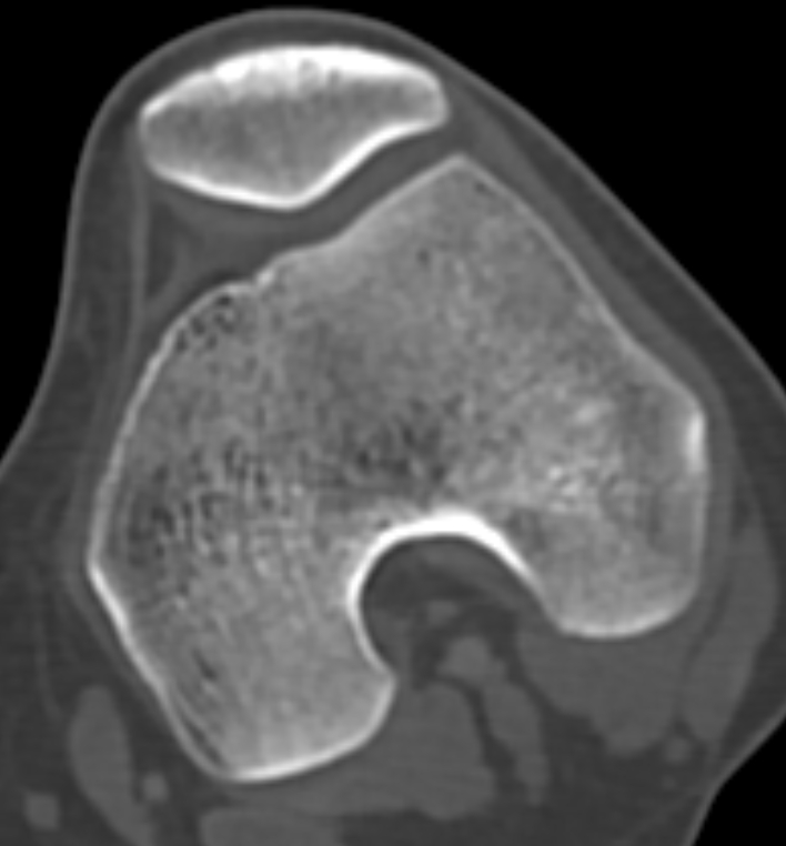 Non-ossifying fibroma - femur (Radiopaedia 82786-97042 Axial bone window 52).jpg