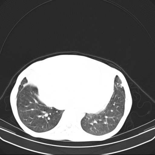 File:Non hodgkin lymphoma of the mediastinum (Radiopaedia 20814-20729 Axial lung window 40).jpg