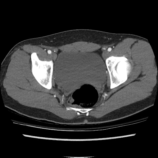 File:Normal CT angiogram of pelvis (Radiopaedia 45390-49430 A 43).jpg