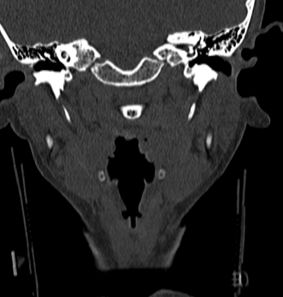 File:Normal CT cervical spine - 12-year-old (Radiopaedia 55352-61775 Coronal bone window 21).jpg