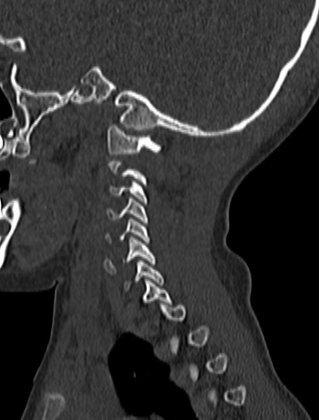 File:Normal CT cervical spine - pediatric (Radiopaedia 52549-58462 Sagittal bone window 35).jpg