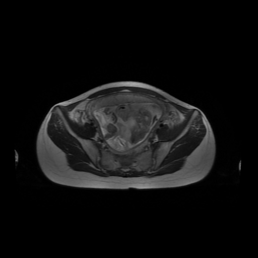 File:Normal MRI abdomen in pregnancy (Radiopaedia 88001-104541 Axial T2 54).jpg