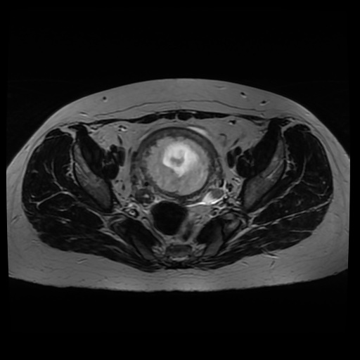 Normal MRI abdomen in pregnancy (Radiopaedia 88005-104548 Axial T2 29).jpg