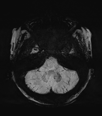 Normal MRI internal auditory canal (Radiopaedia 41613-44525 Axial SWI MIP 16).png