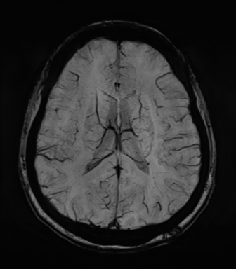Normal MRI internal auditory canal (Radiopaedia 41613-44525 Axial SWI MIP 48).png