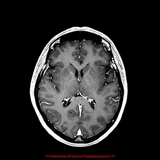 Normal adult brain MRI (non-enhanced and contrast-enhanced) (Radiopaedia 75262-86379 Axial T1 C+ 107).jpg
