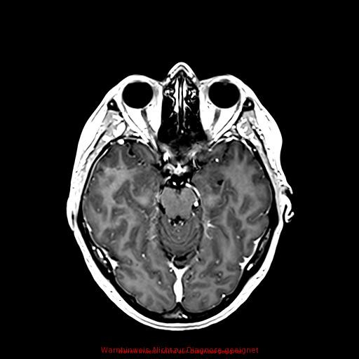 Normal adult brain MRI (non-enhanced and contrast-enhanced) (Radiopaedia 75262-86379 Axial T1 C+ 86).jpg