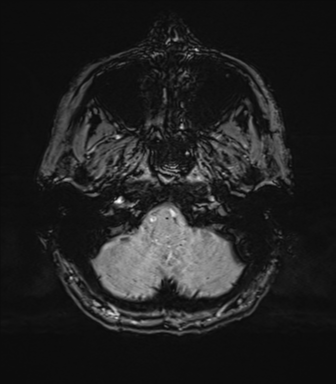 Normal brain MRI (TLE protocol) (Radiopaedia 40748-43405 Axial SWI 10).png