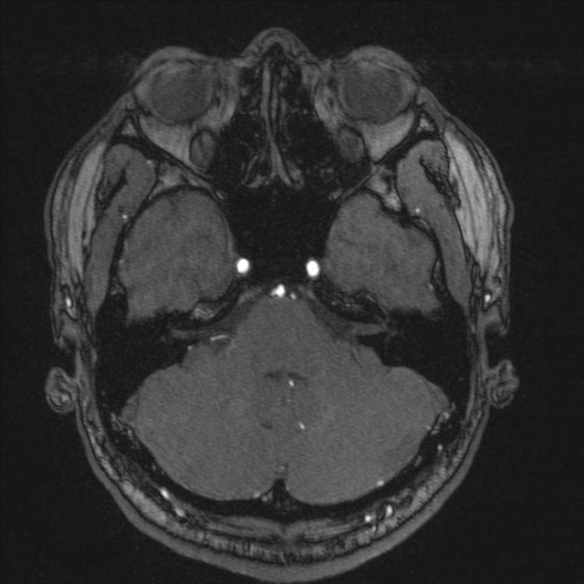 Normal brain MRI including MRA (Radiopaedia 48748-53763 Axial MRA 46).jpg