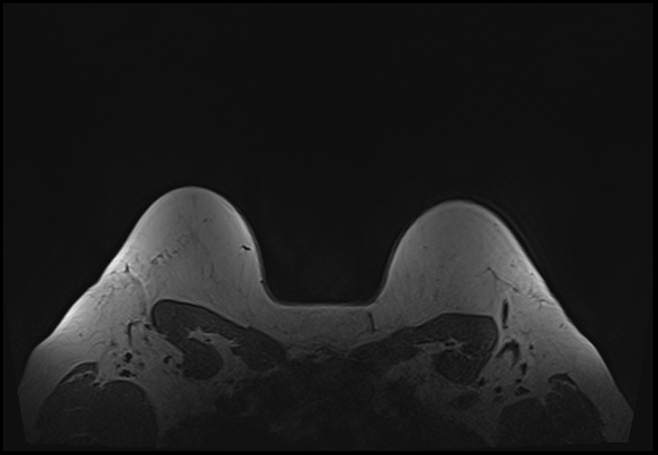 File:Normal breast MRI - dense breasts (Radiopaedia 80454-93850 Axial T1 201).jpg