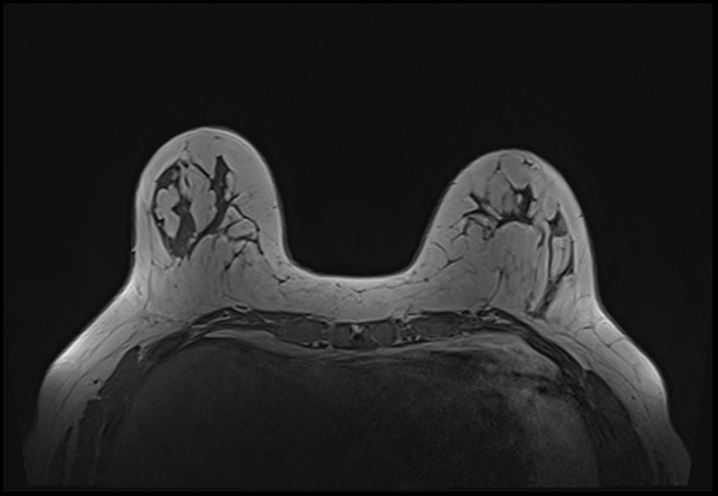 File:Normal breast MRI - dense breasts (Radiopaedia 80454-93850 Axial T1 62).jpg