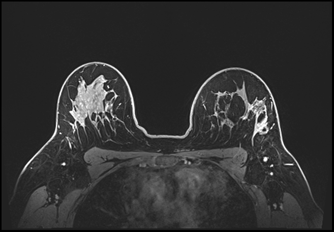 Normal breast MRI - dense breasts (Radiopaedia 80454-93850 C 154).jpg