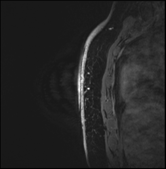Normal breast MRI - dense breasts (Radiopaedia 80454-93850 I 154).jpg