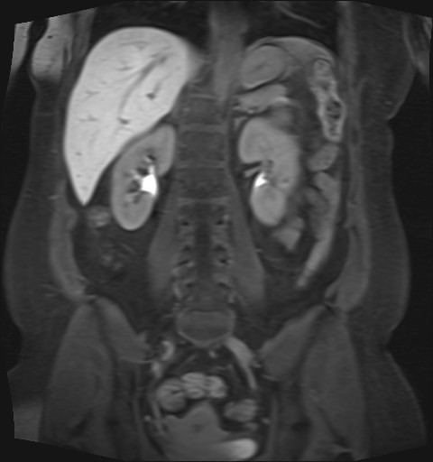 File:Normal hepatobiliary phase liver MRI (Radiopaedia 58968-66230 B 19).jpg