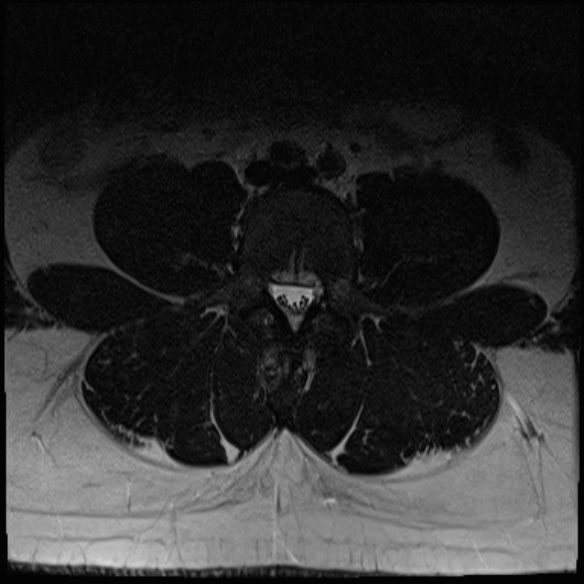 File:Normal lumbar spine MRI (Radiopaedia 47857-52609 Axial T2 12).jpg