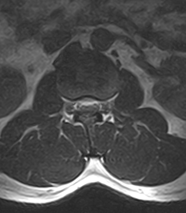 Normal lumbar spine MRI - low-field MRI scanner (Radiopaedia 40976-43699 Axial T2 29).jpg