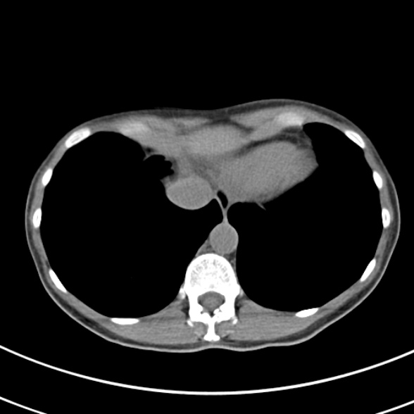 File:Normal multiphase CT liver (Radiopaedia 38026-39996 Axial non-contrast 3).jpg