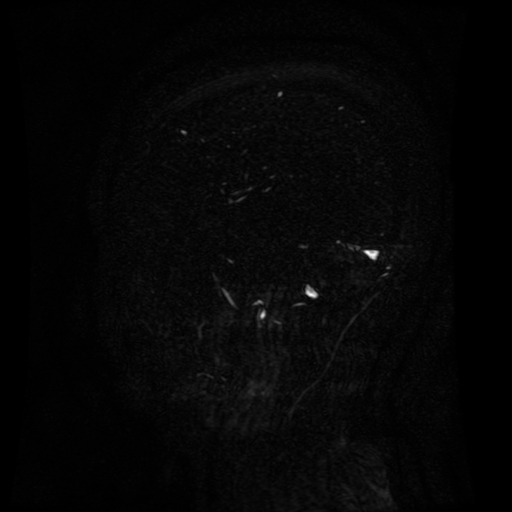 Normal noncontrast MR venography (Radiopaedia 87578-103957 A 139).jpg