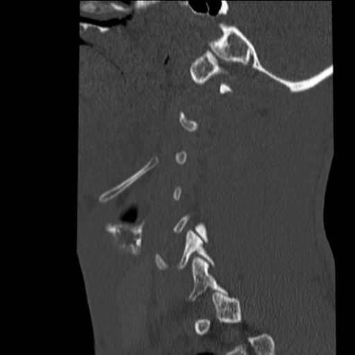 File:Normal trauma cervical spine (Radiopaedia 41017-43760 Sagittal bone window 6).png