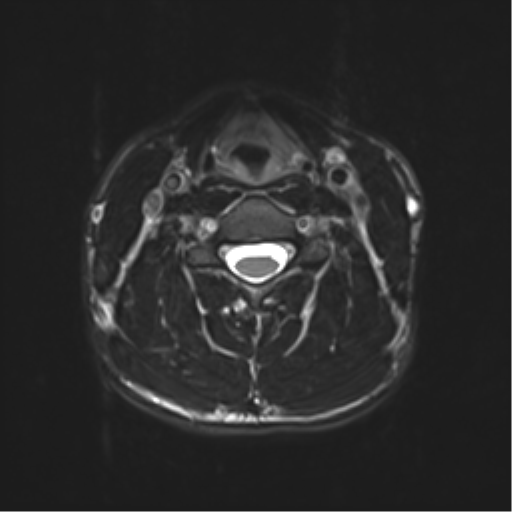 Normal trauma cervical spine (Radiopaedia 41017-43762 D 26).png